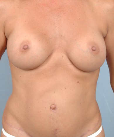After Image: Breast Augmentation – Silicone - front