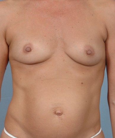 Before Image: Breast Augmentation – Silicone - front
