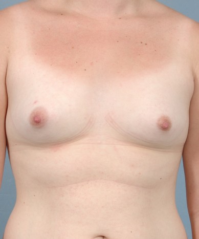 Before Image: Breast Augmentation – Silicone - front