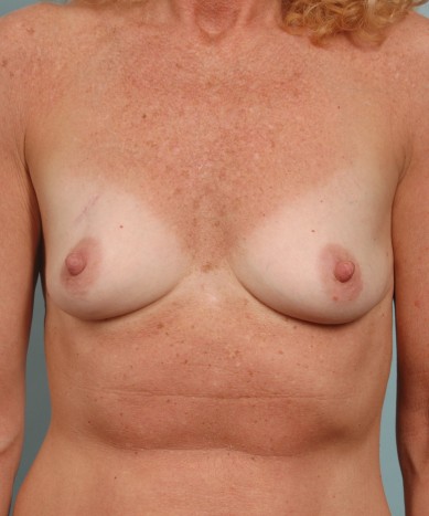 Before Image: Breast Augmentation – Silicone - front