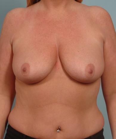 Before Image: Breast Augmentation – Silicone - front