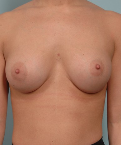 After Image: Breast Augmentation – Silicone - front