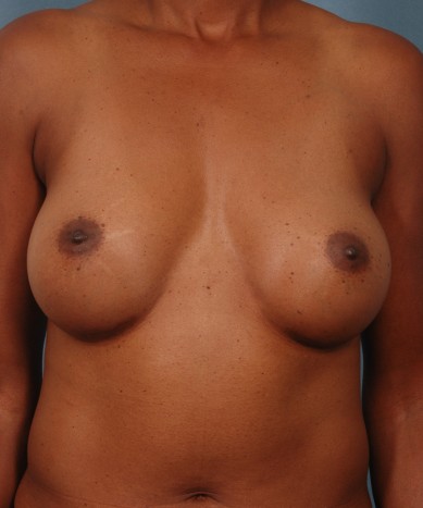 After Image: Breast Augmentation – Silicone - front