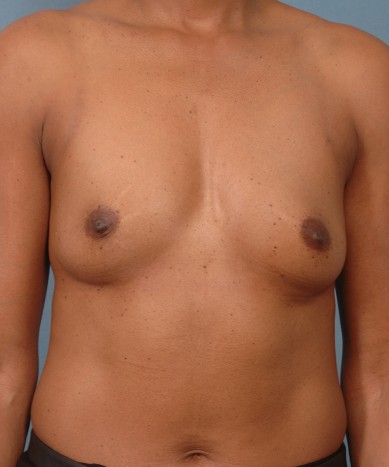 Before Image: Breast Augmentation – Silicone - front