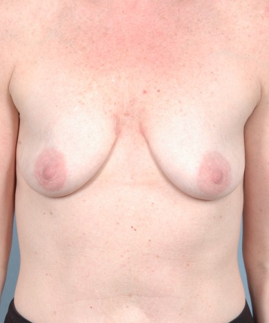 Breast Augmentation – Silicone
