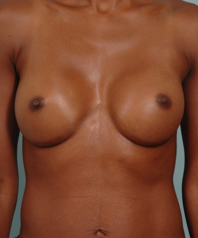 After Image: Breast Augmentation – Silicone - front