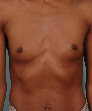 Before Image: Breast Augmentation – Silicone - front