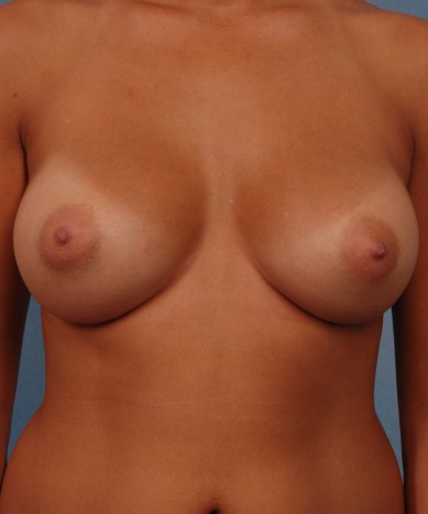 Asymmetric Breasts