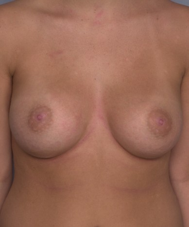 Breast Augmentation – Saline Implants