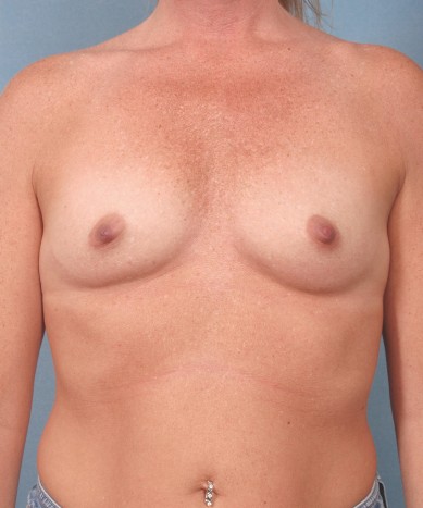 Breast Augmentation – Silicone