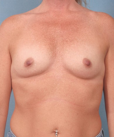 Before Image: Breast Augmentation – Silicone - front