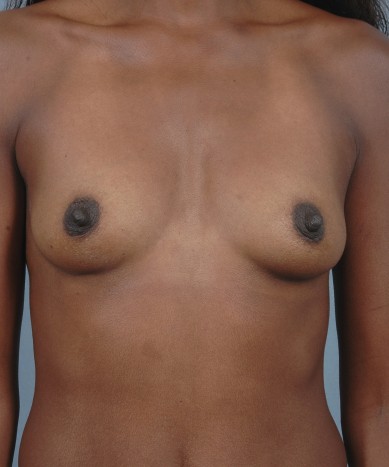 Before Image: Breast Augmentation – Silicone - front