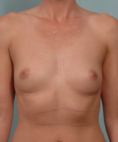 Before Image: Breast Augmentation – Silicone - front