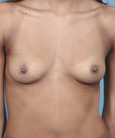 Before Image: Breast Augmentation – Silicone - front