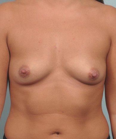 Before Image: Breast Augmentation – Silicone - front