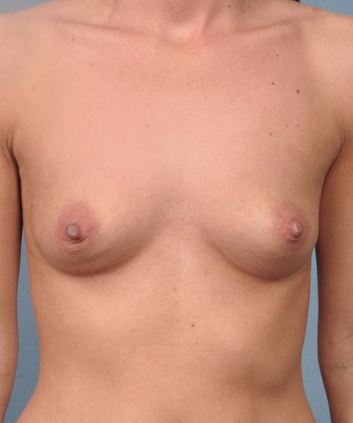Before Image: Breast Augmentation – Silicone - front