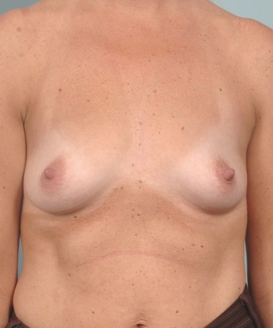 Before Image: Breast Augmentation – Silicone - front