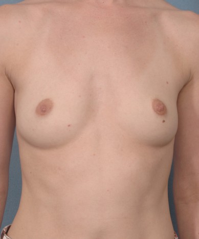 Before Image: Breast Augmentation – Silicone - front