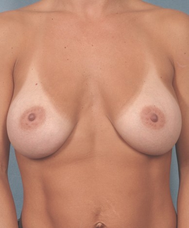 After Image: Breast Augmentation – Silicone - front