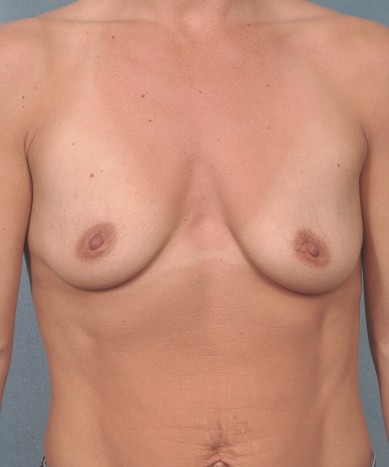 Before Image: Breast Augmentation – Silicone - front