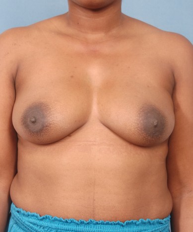 Before Image: Breast Augmentation – Silicone - front