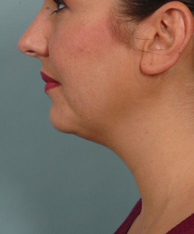 VASER 4D liposuction of the neck