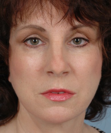 After Image: Facelift - front