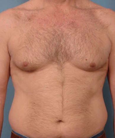 Gynecomastia