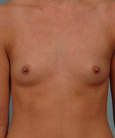 Breast augmentation – Silicone “Gummy bear” implants