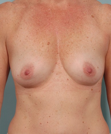 Breast augmentation – Silicone “Gummy bear” implants