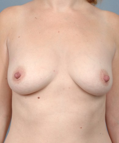 Breast Augmentation – Saline Implants