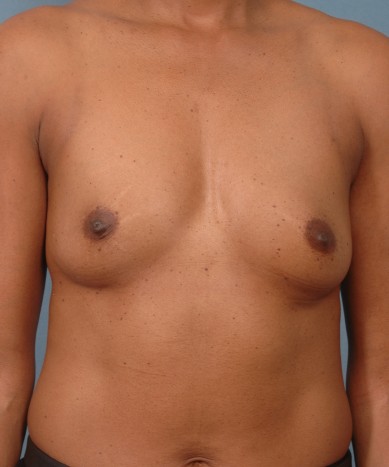 Breast Enhancement with Silicone Round Implants