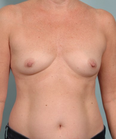 Breast Enhancement with Silicone Round Implants