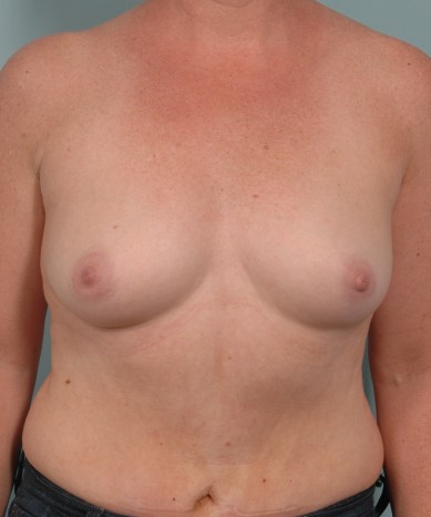 Breast Enhancement with Silicone – Allergan 410 “Gummy Bear” Implants