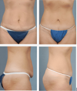 mommy makeover in long island | Mark Epstein MD mommy makeover in long island | Mark Epstein MD