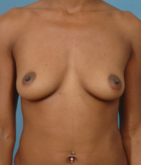 Breast Augmentation | Breast Enhancement | Long Island