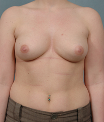 Breast Augmentation | Breast Enhancement | Long Island