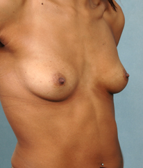 Breast Augmentation | Breast Enhancement | Long Island