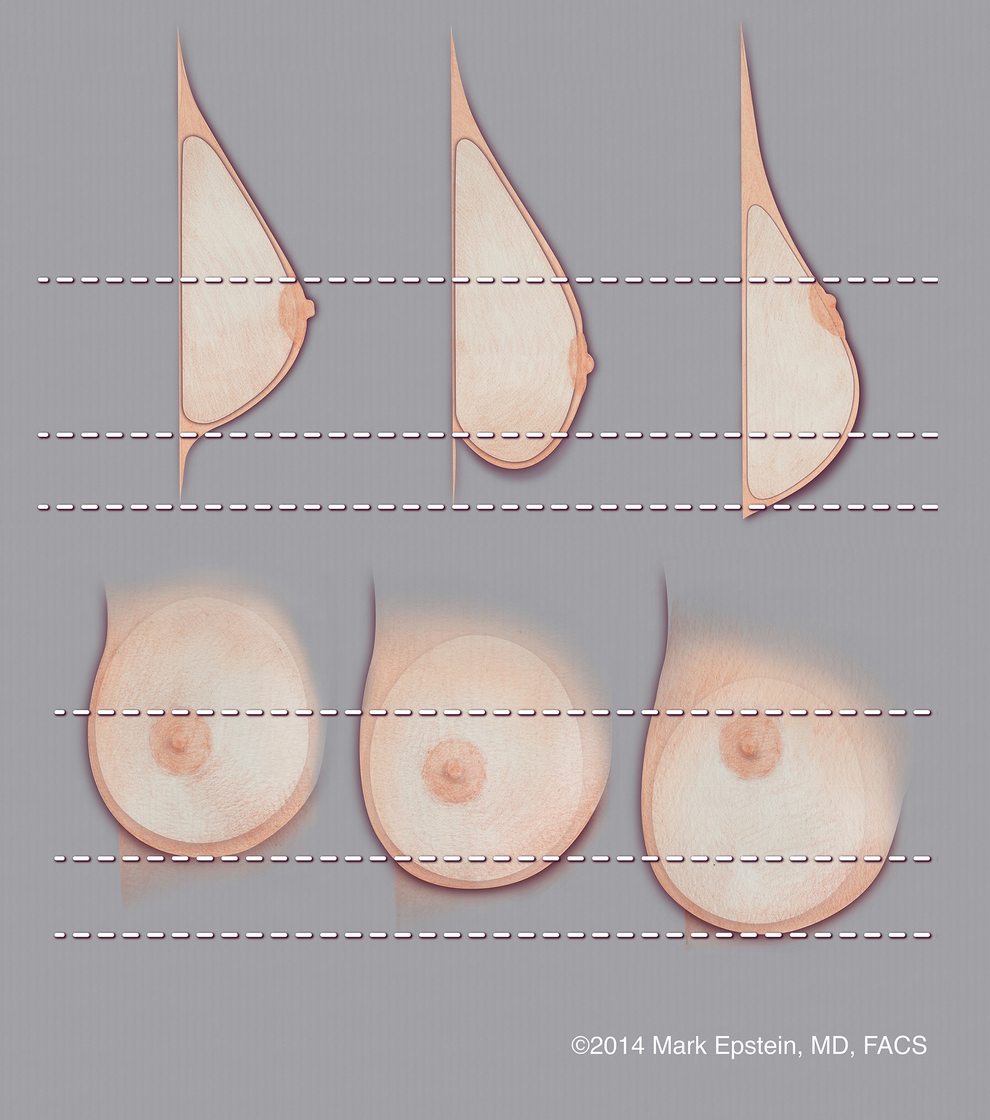 breast augmentation bottom out Hardcore latex bisexual orgy