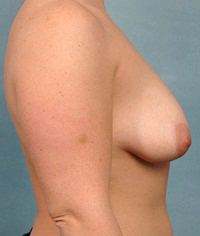 Silicone Gel Breast Implants Long Island
