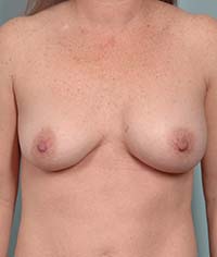 Saline Implant Deflation Correction | Saline Implant Malposition Correction | Long Island