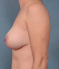Saline Implant Deflation Correction | Saline Implant Malposition Correction | Long Island