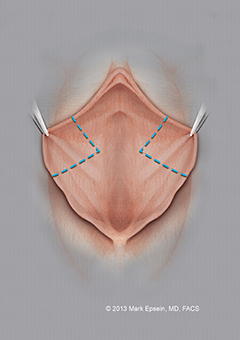 Labiaplasty Long Island Labiaplasty Long Island