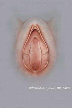 Labiaplasty Long Island Labiaplasty Long Island