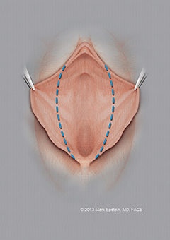 Labiaplasty Long Island Labiaplasty Long Island