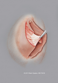 Labiaplasty Long Island Labiaplasty Long Island