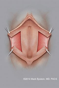 Labiaplasty Long Island Labiaplasty Long Island