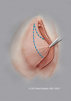 Labiaplasty Long Island Labiaplasty Long Island