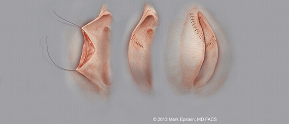 Labiaplasty Long Island Labiaplasty Long Island