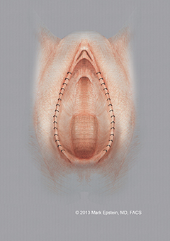 Labiaplasty Long Island Labiaplasty Long Island